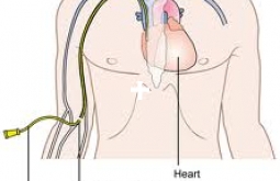 catheters centraux-1